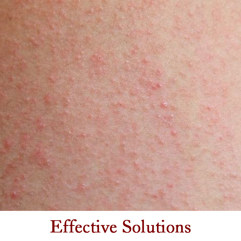 Treating red, itchy eczema patches with natural remedies.